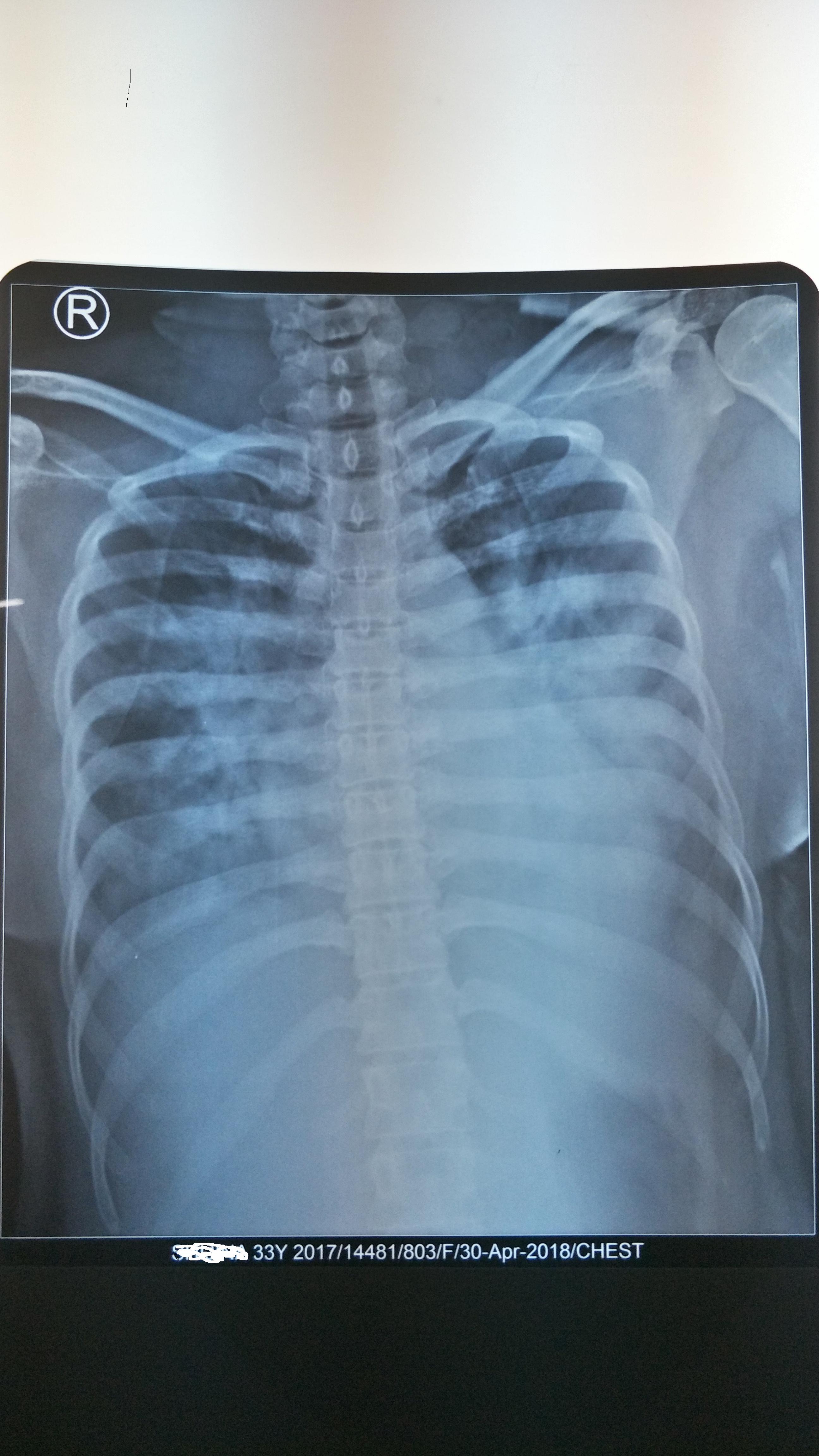 A Rare Case Of Amlodipine Overdose
