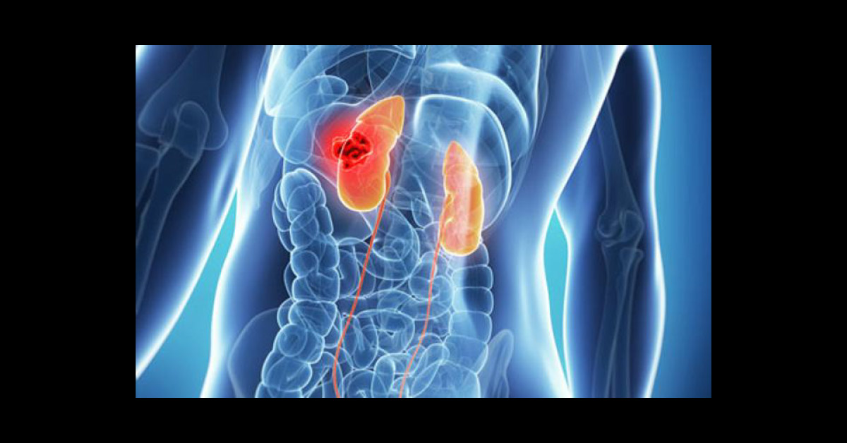 Obesity Surgery Prevents Severe Chronic Kidney Disease And Kidney Failure