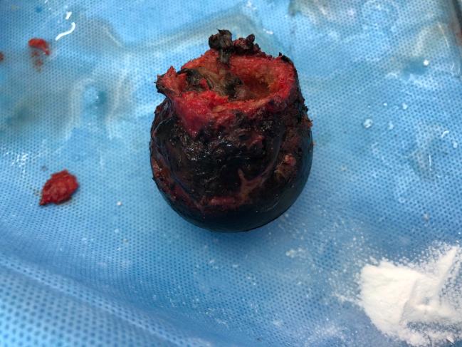 Bilateral Black Hip- Rare Anomaly
