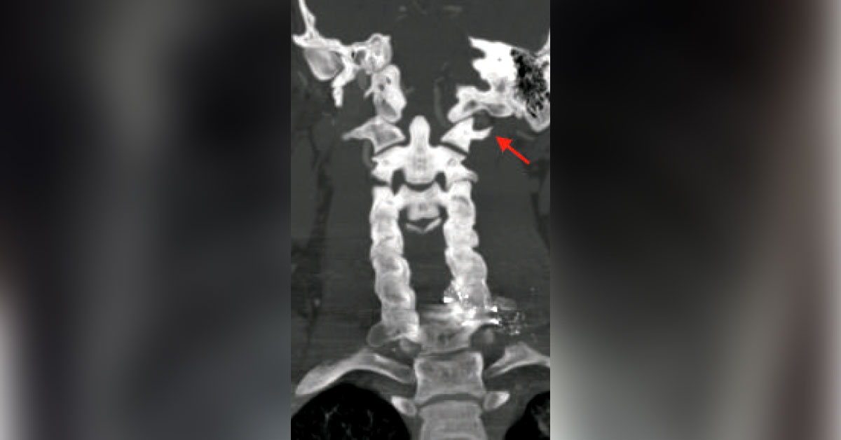 A Case of Gunshot Over the Left Scapula