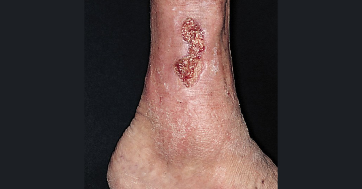 A Man with Non-healing Ulceration on the Leg