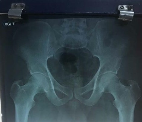 Osteoporosis Or Osteopenia In Neck Of Femur?