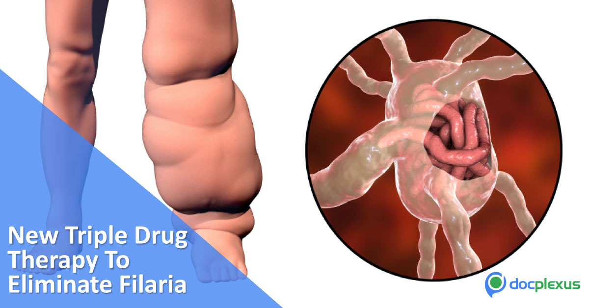 New Triple Drug Therapy Rolled Out To Eradicate Filarial Infection