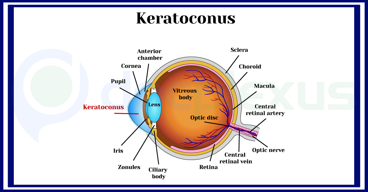 Brief Essay On Keratoconus