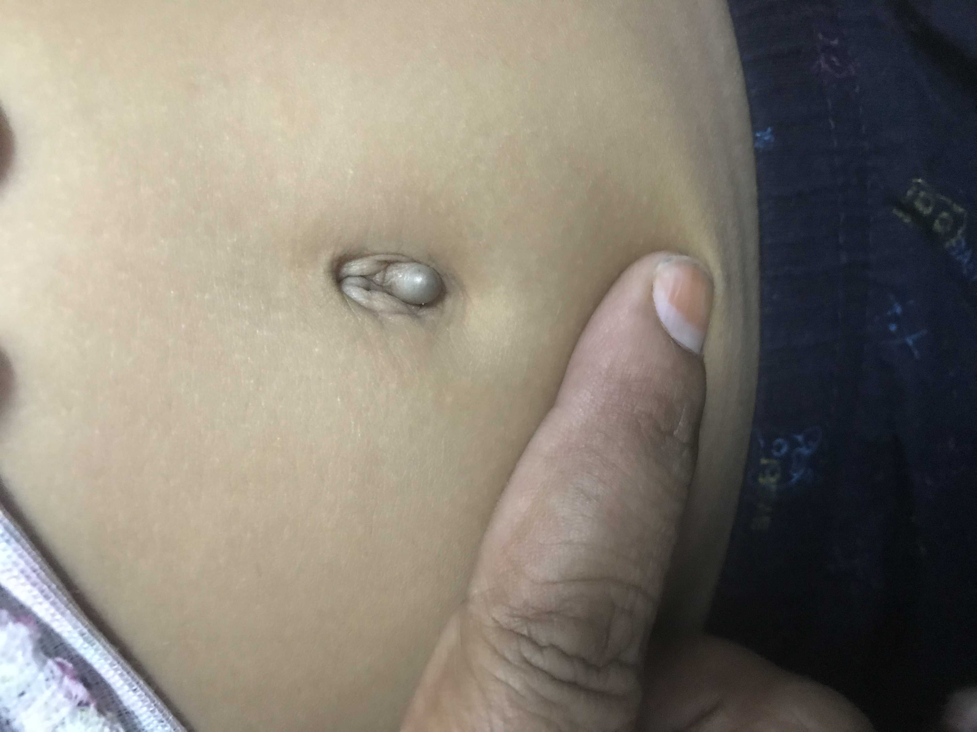 What Is This Protruding From Umbilical Button?