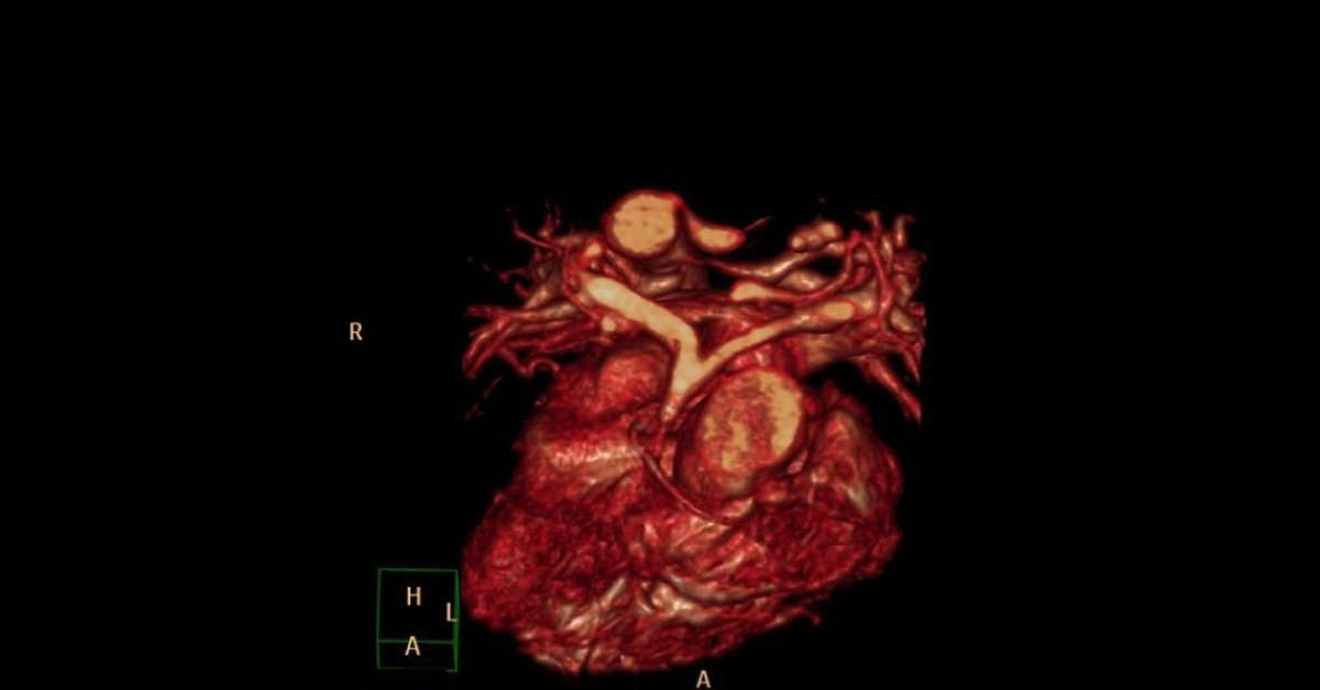 Child with Ventricular Septal Defect