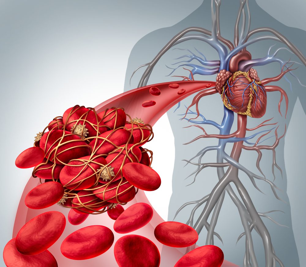 New Report On Efficacy Of Direct Oral Anti-Coagulants For DVT In Cancer