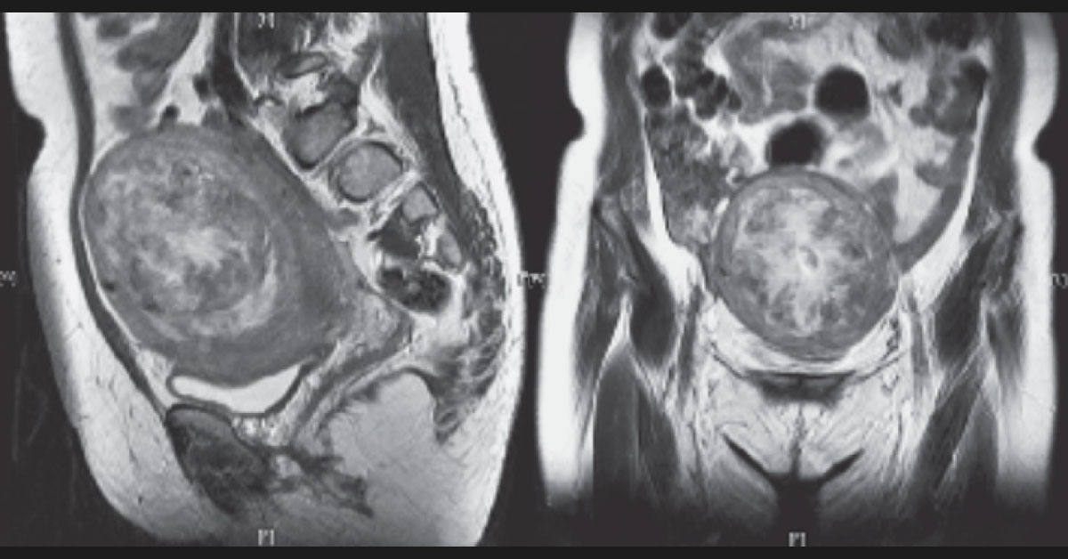 A Woman With Abdominal Swelling