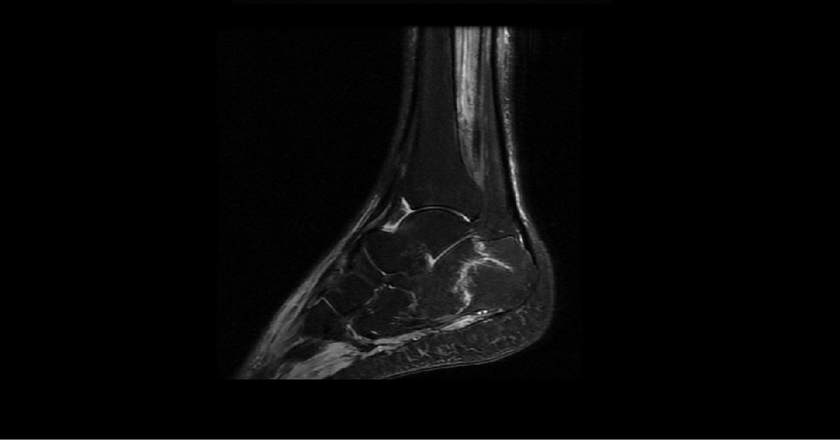 What Type Of Fracture Is This?