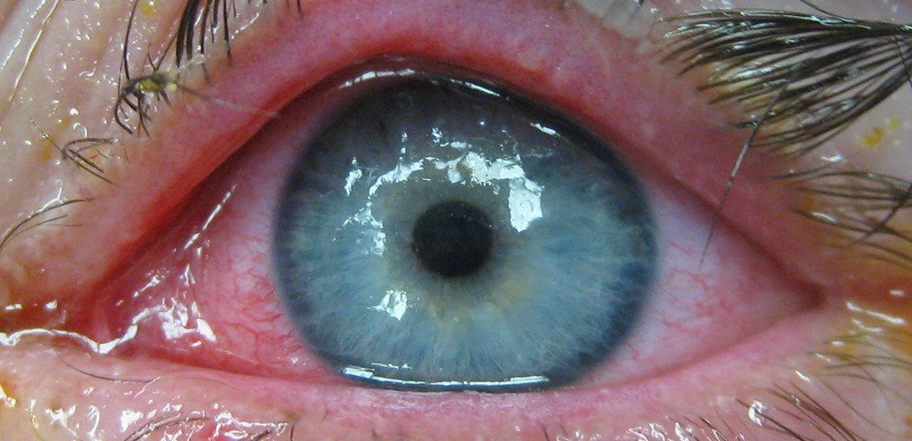 Steven Johnsons Syndrome