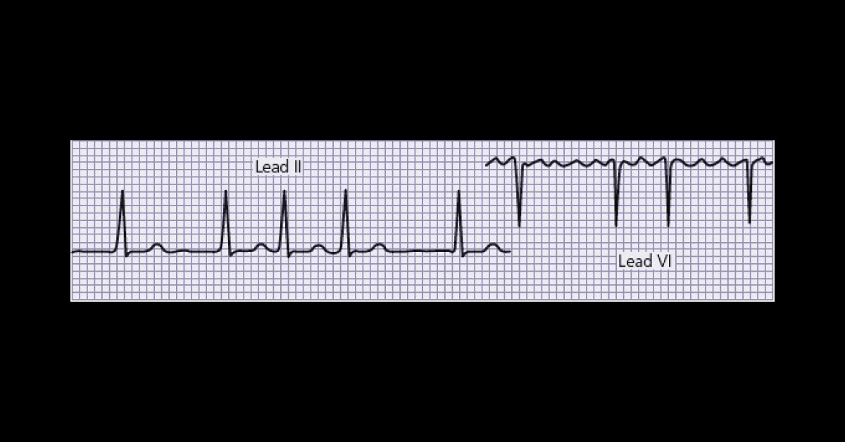 Elderly Woman with Palpitations
