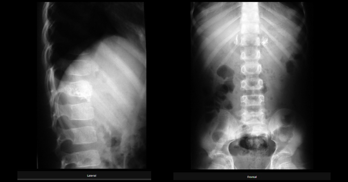 Backache in a Middle-aged Male