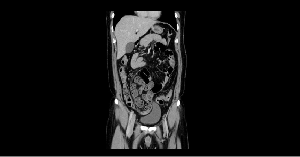 Diagnose The Gastrointestinal Abnormality From The CT Scan?