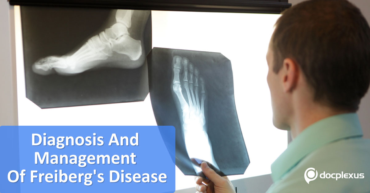 Diagnosis And Management Of Freiberg’s Disease