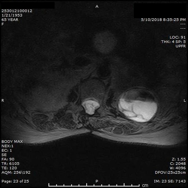Case Findings Of Neurofibromatosis Type 2