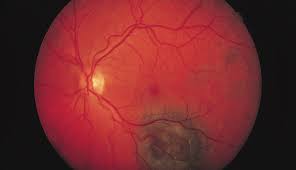 Brief Review On Atypical Manifestations Of Choroidal Melanom