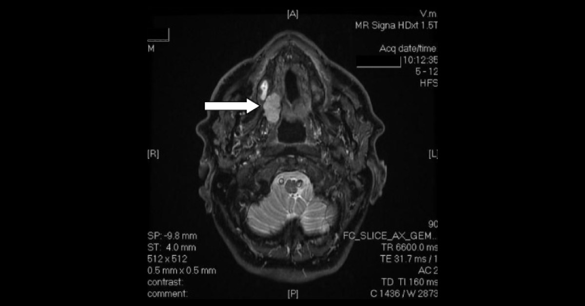 Severe Coughing Following Maxillectomy