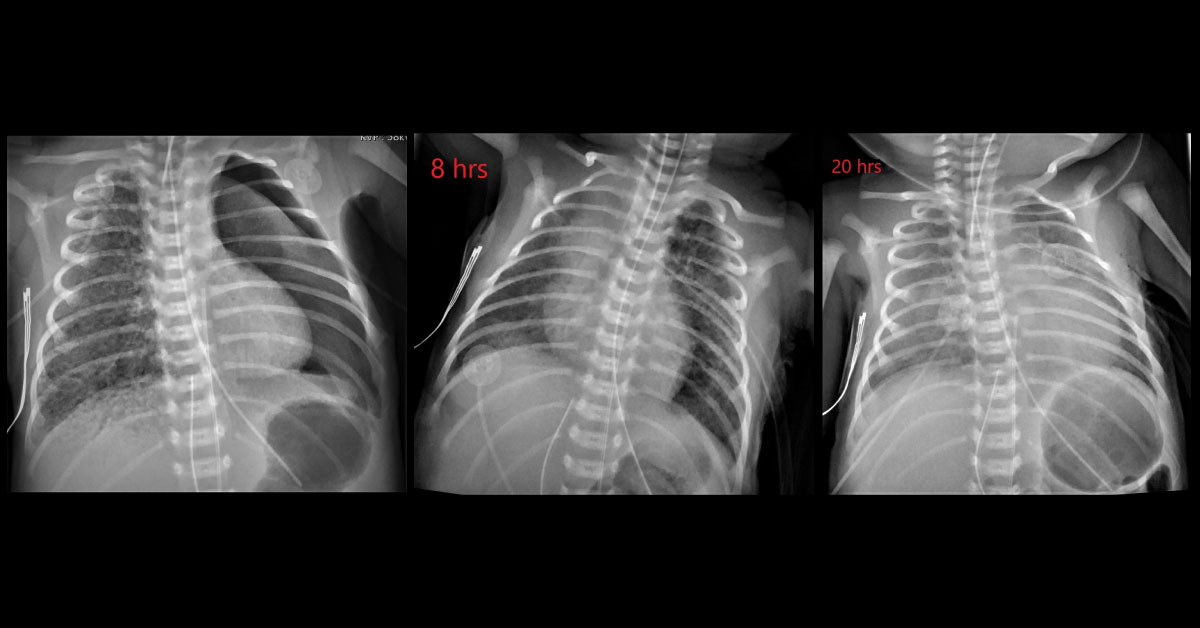 Diagnose The Abnormality In This Newborn