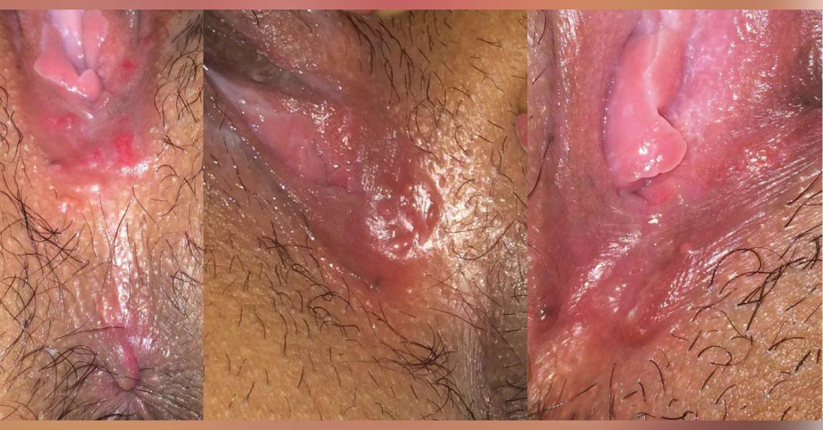 What Are These Skin Lesions? 