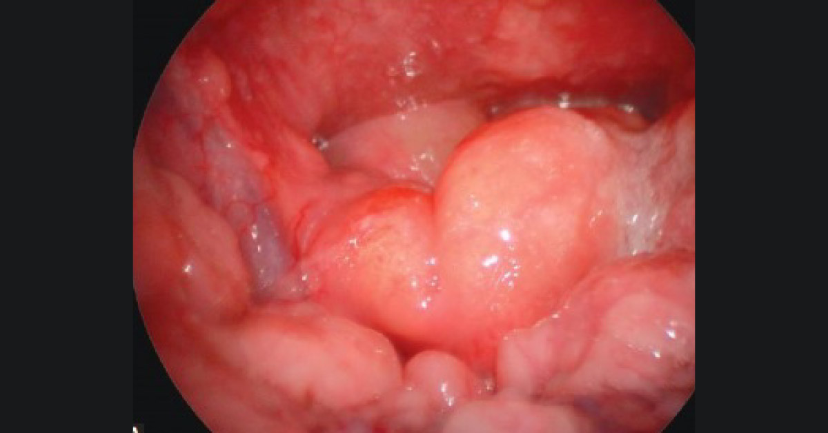 Sudden Onset of Hoarseness and Stridor