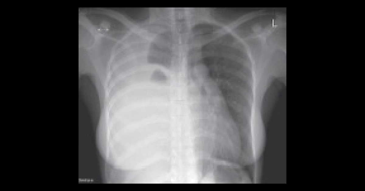 What's Causing Increasing Breathlessness in This Woman with a History of Breast Cancer?