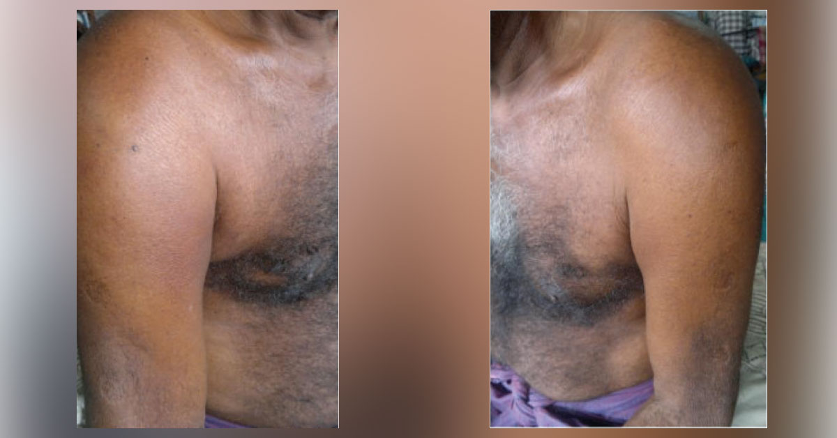 Case of Muscle Pain in the Upper Limbs