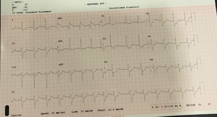 Asymptomatic Patient With Abnormal ECG- Collapsed