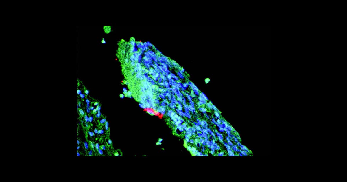 In Which Disease Does Gallbladder Carriage Occur?