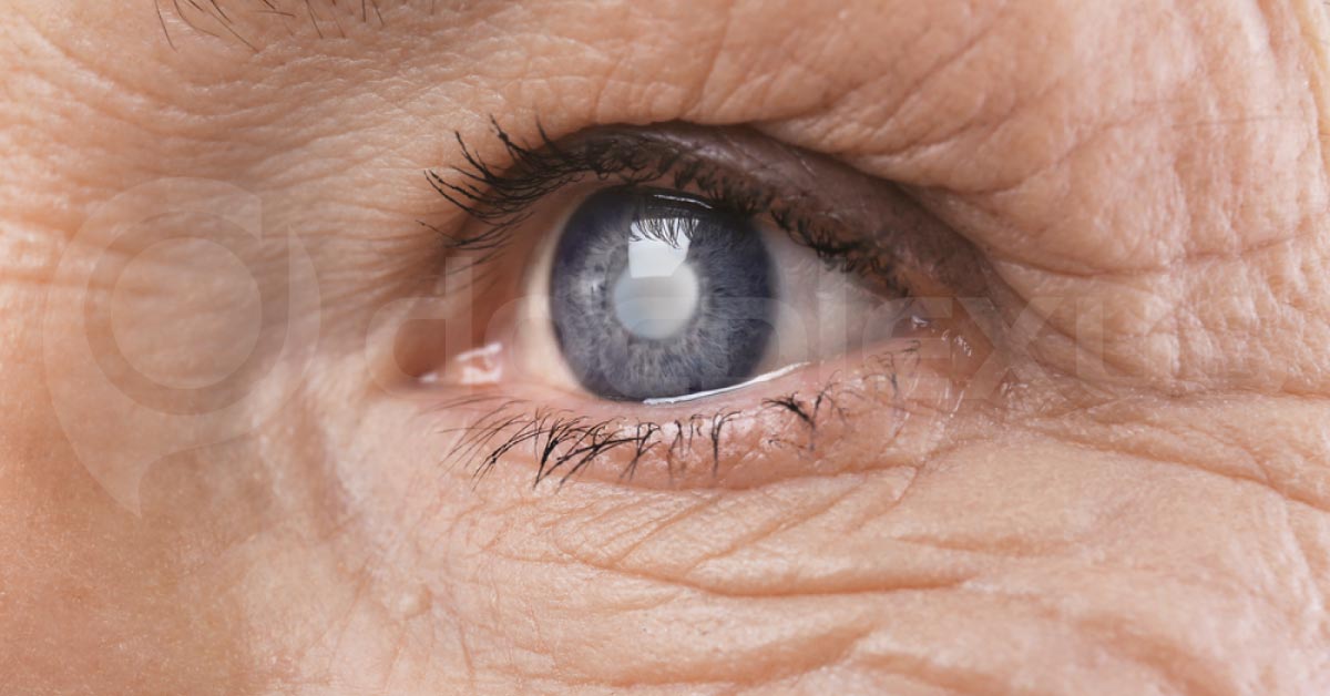 Old Vs Present Day Cataract Surgery Scenario