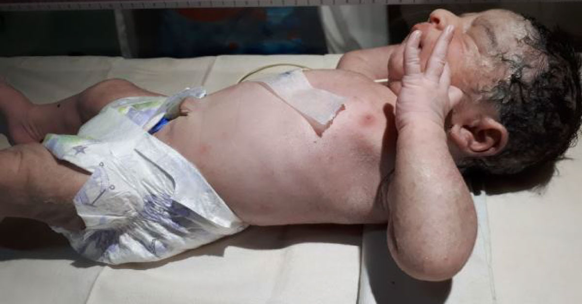 Newborn With Rashes At Birth 