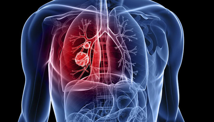 Biomarker For Early Diagnosis Of Lung Cancer Identified