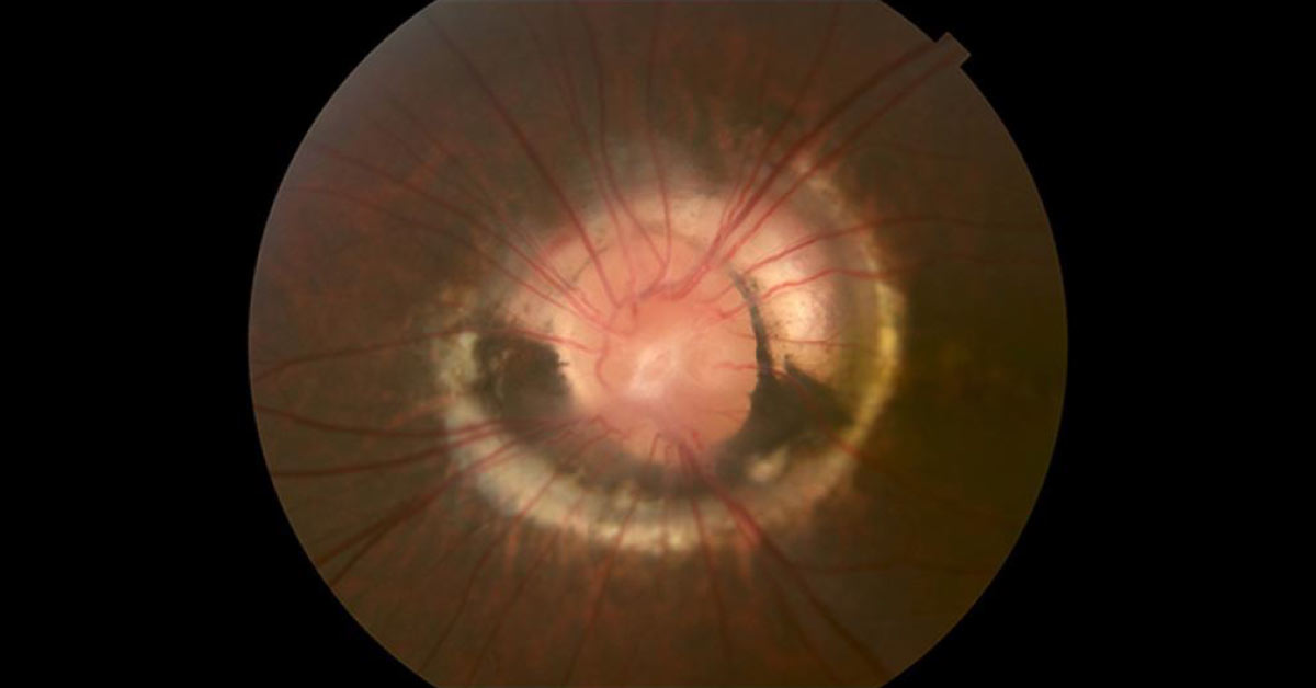 Some Of The Associated Congenital Optic Disc Conditions
