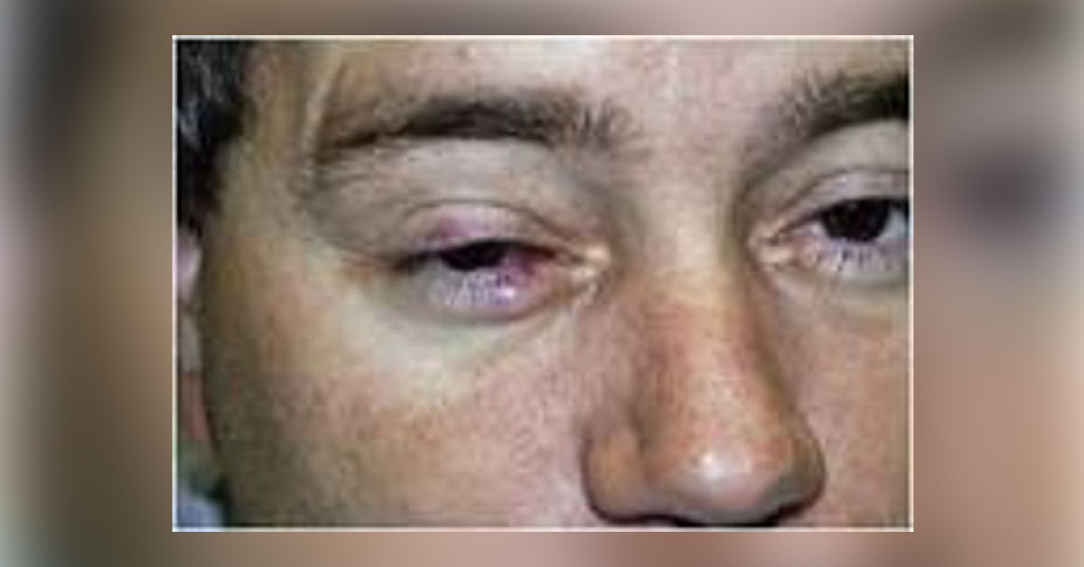 Brief Review On Ocular Manifestations Of Psoriasis
