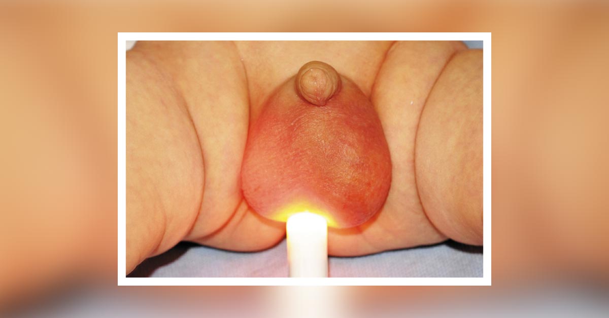 Baby Boy With Scrotal Pain