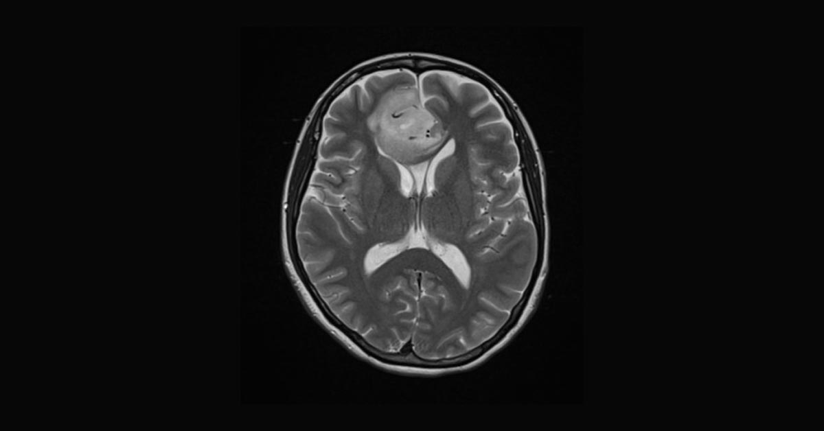 Diagnose This Neurologic Disorder