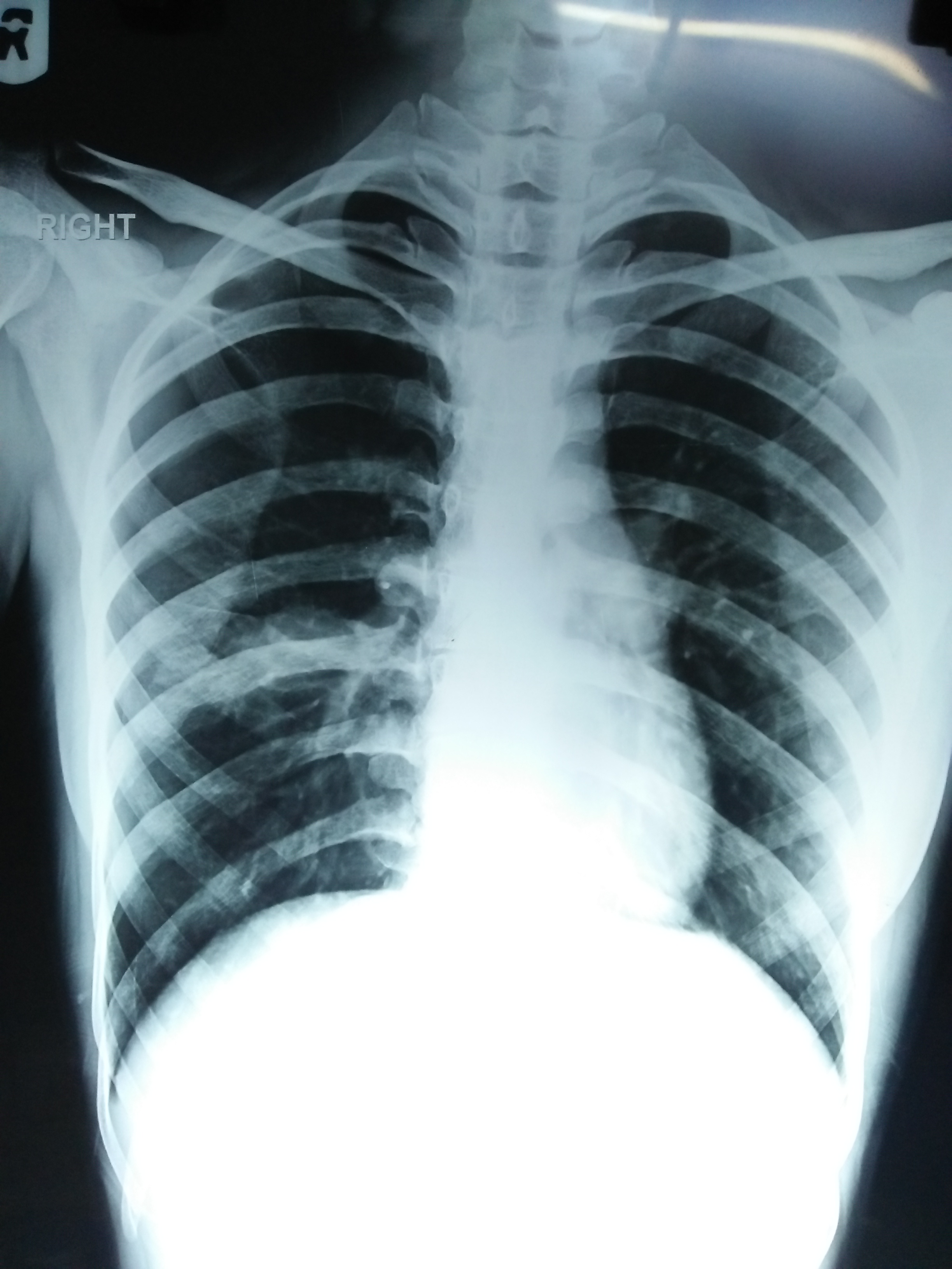 What Is Cause Of Pneumothorax? 