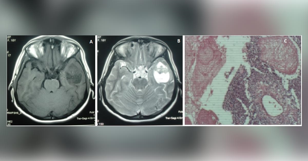Can You Diagnose This Woman with Headache and Blurred Vision?