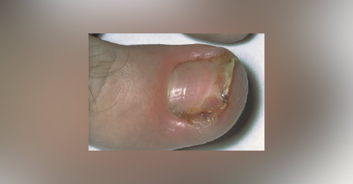 A Septic Toe