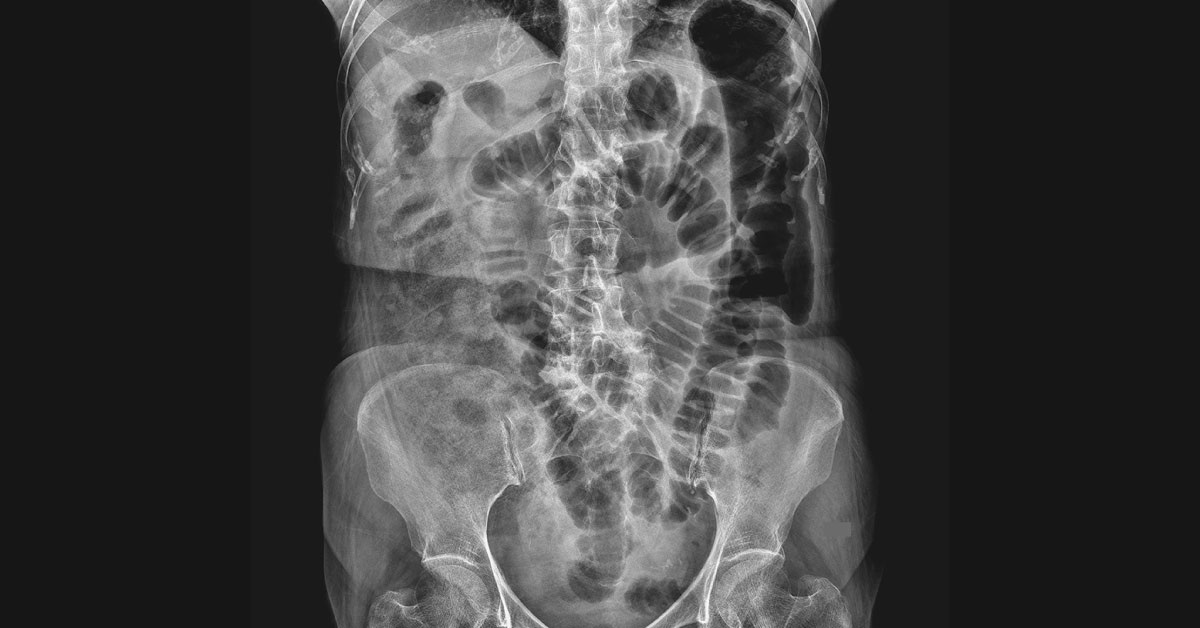 The Colon Cutoff Sign Indicates Which Condition?
