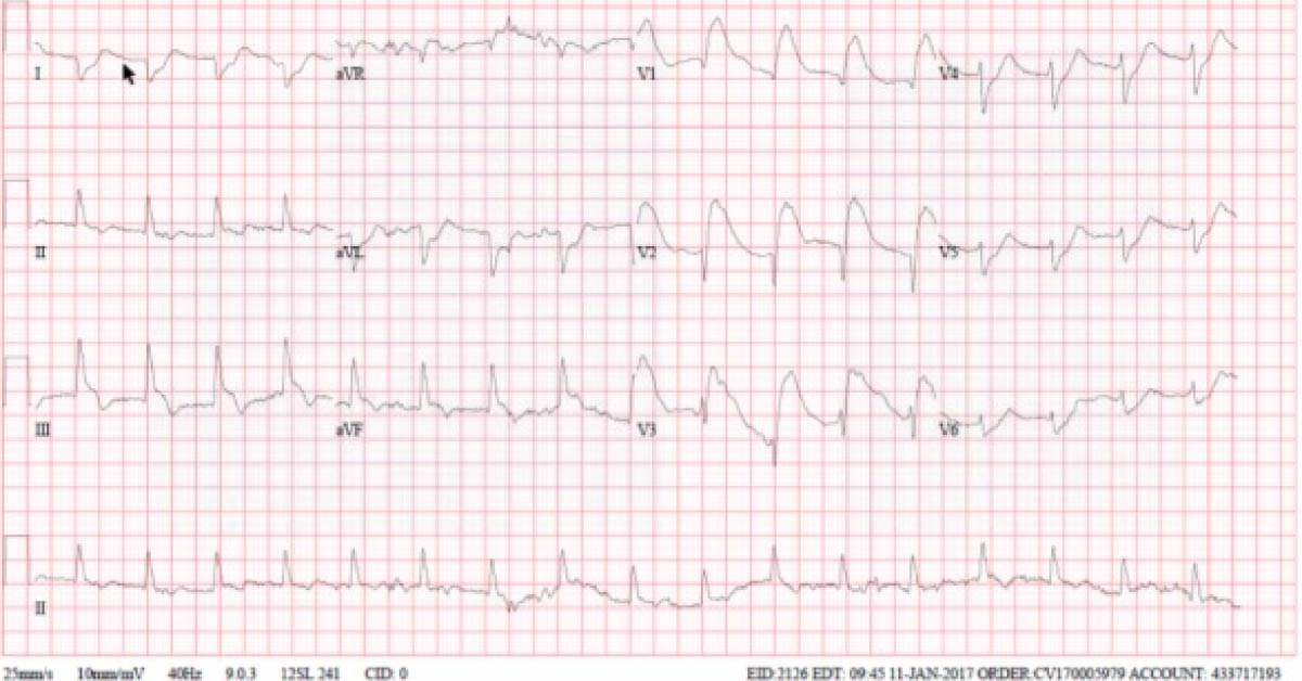 Case of a Geriatric Patient Who Suffered from Pulseless Electrical Activity Cardiac Arrest