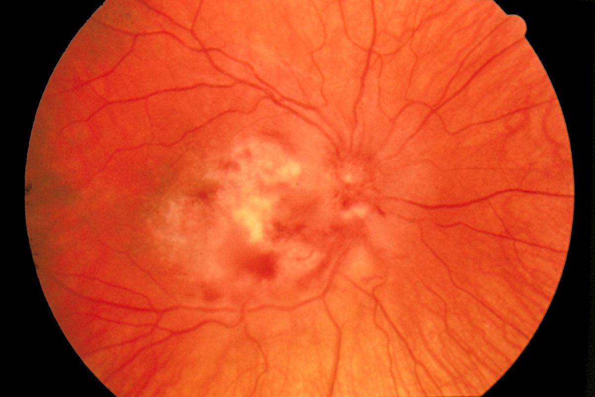 Signs And Symptoms Caused By Cytomegalic Infection