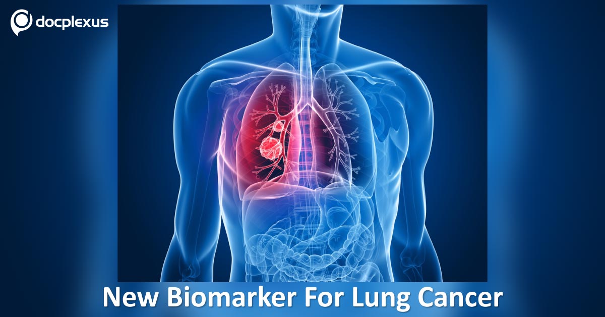 New Biomarker Identified For Early Detection Of Lung Cancer