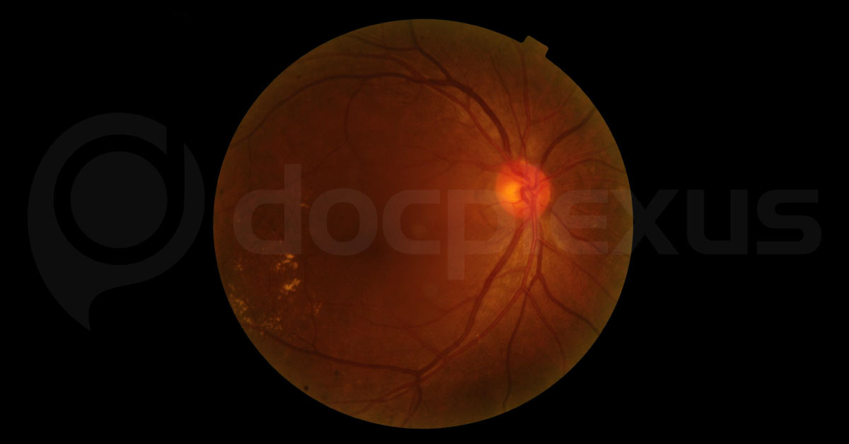 Some Of The Main Ocular Manifestations Of AIDS