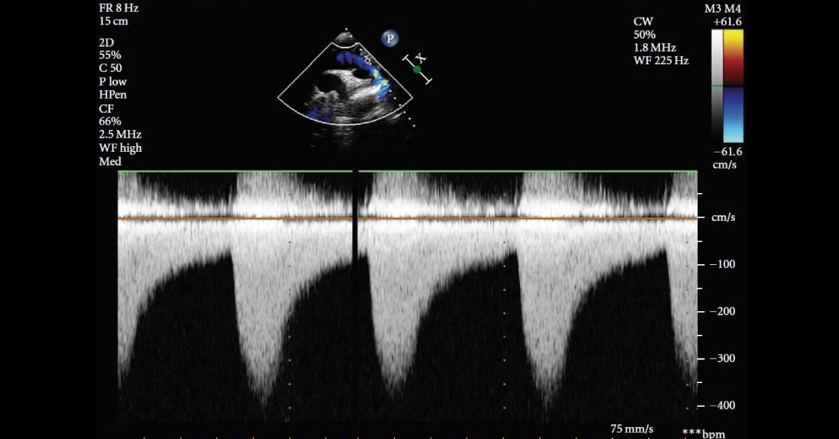 Female With Chest Discomfort