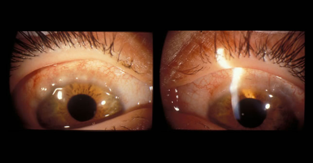 Spot the Ophthalmic Abnormality