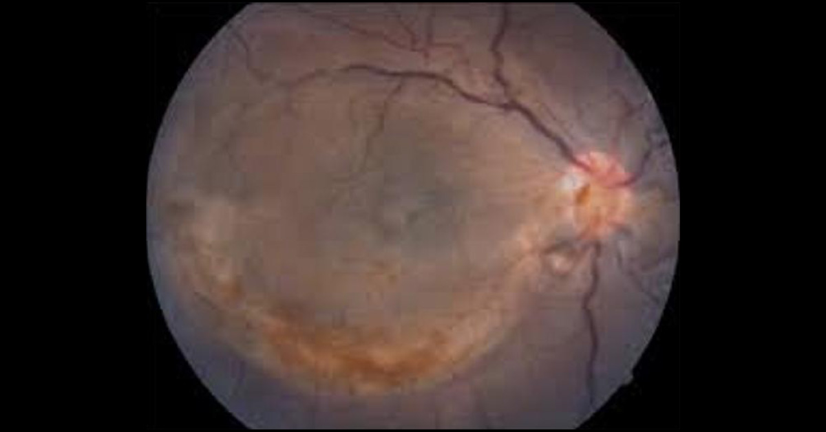 Brief Review On Ocular Manifestations Of Dengue Fever