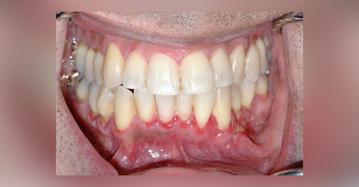 A Case of Diffuse Gingival Redness