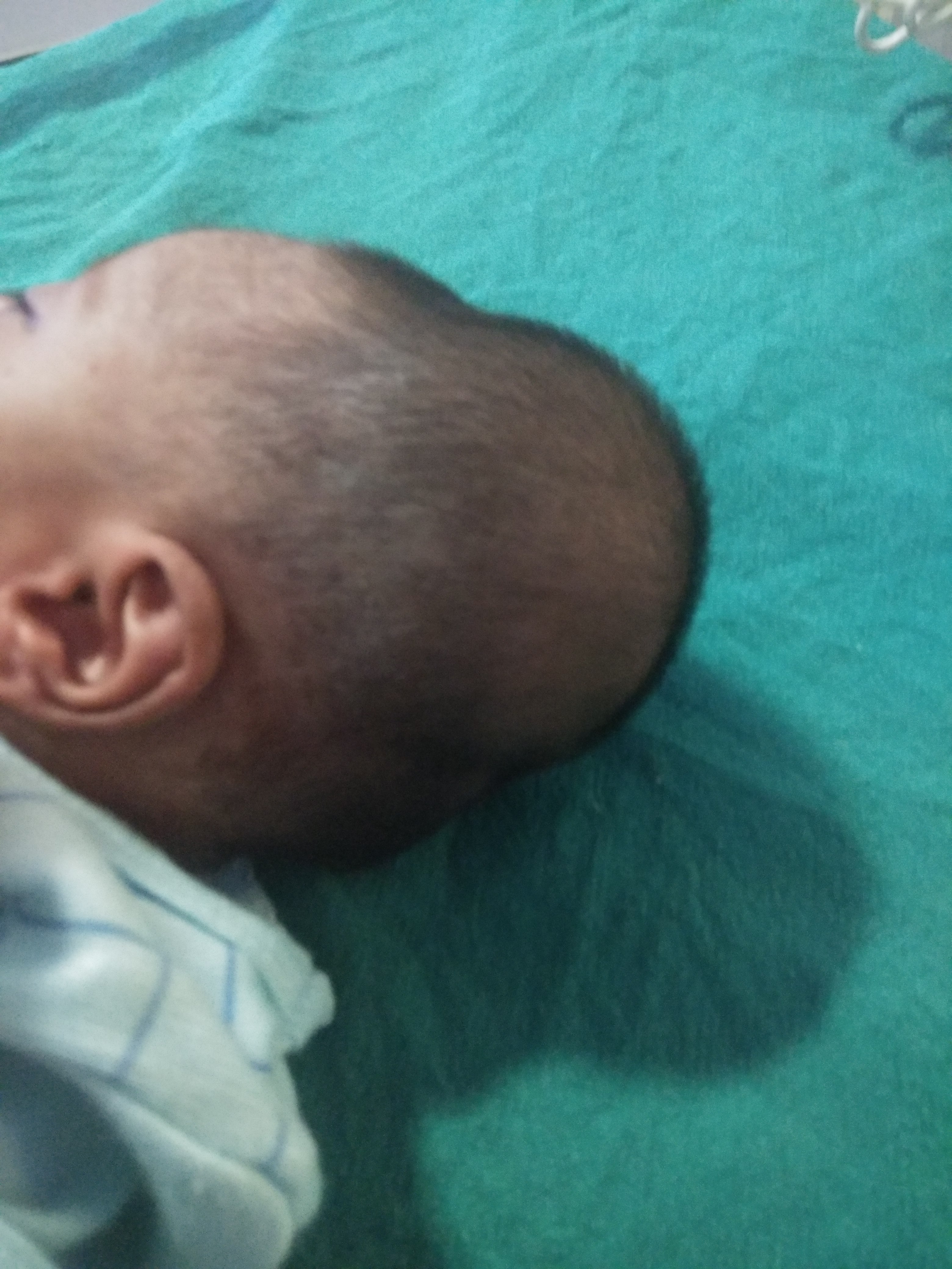 Swelling Over Scalp