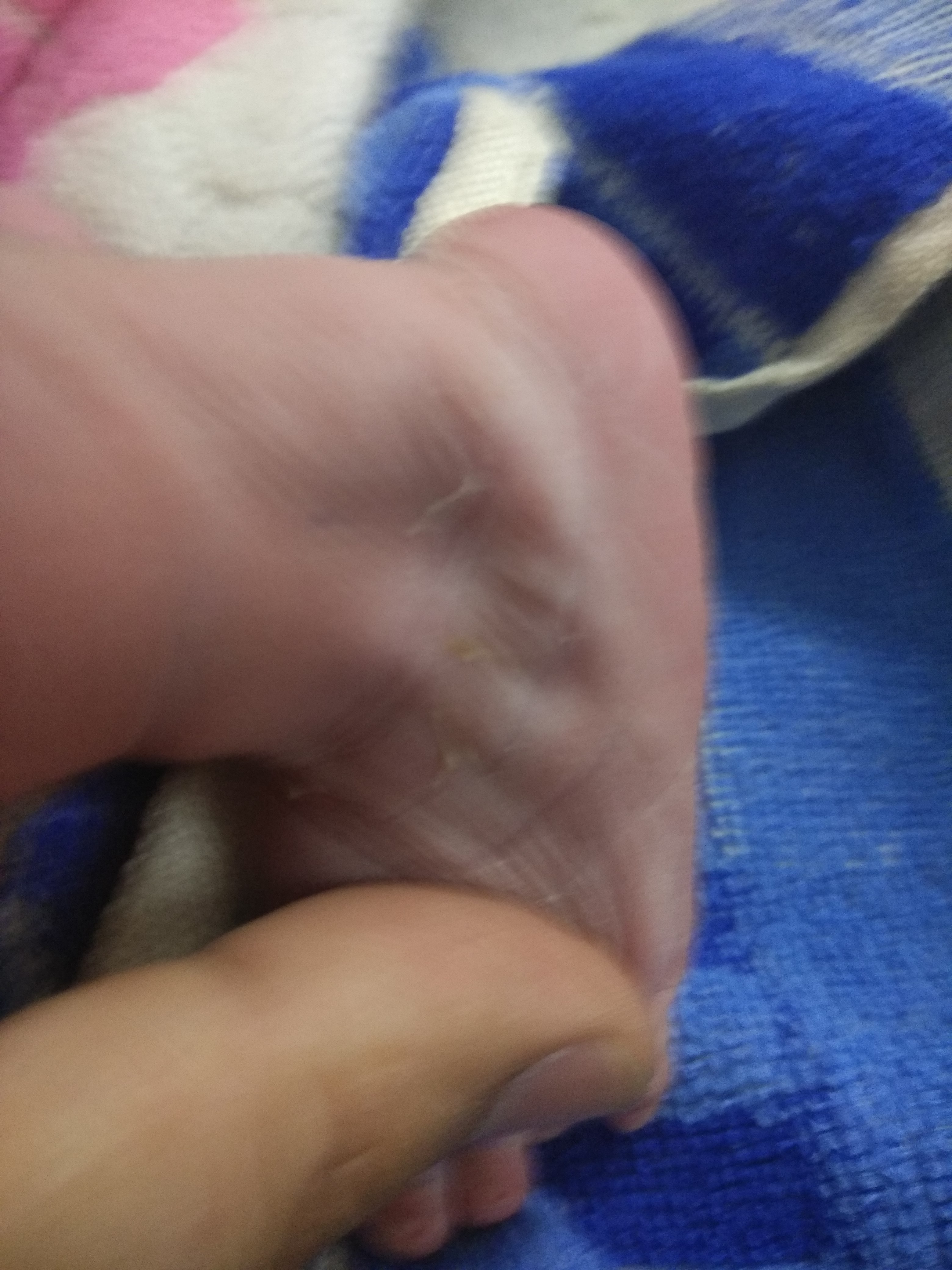 Depression Near Lateral Malleolus