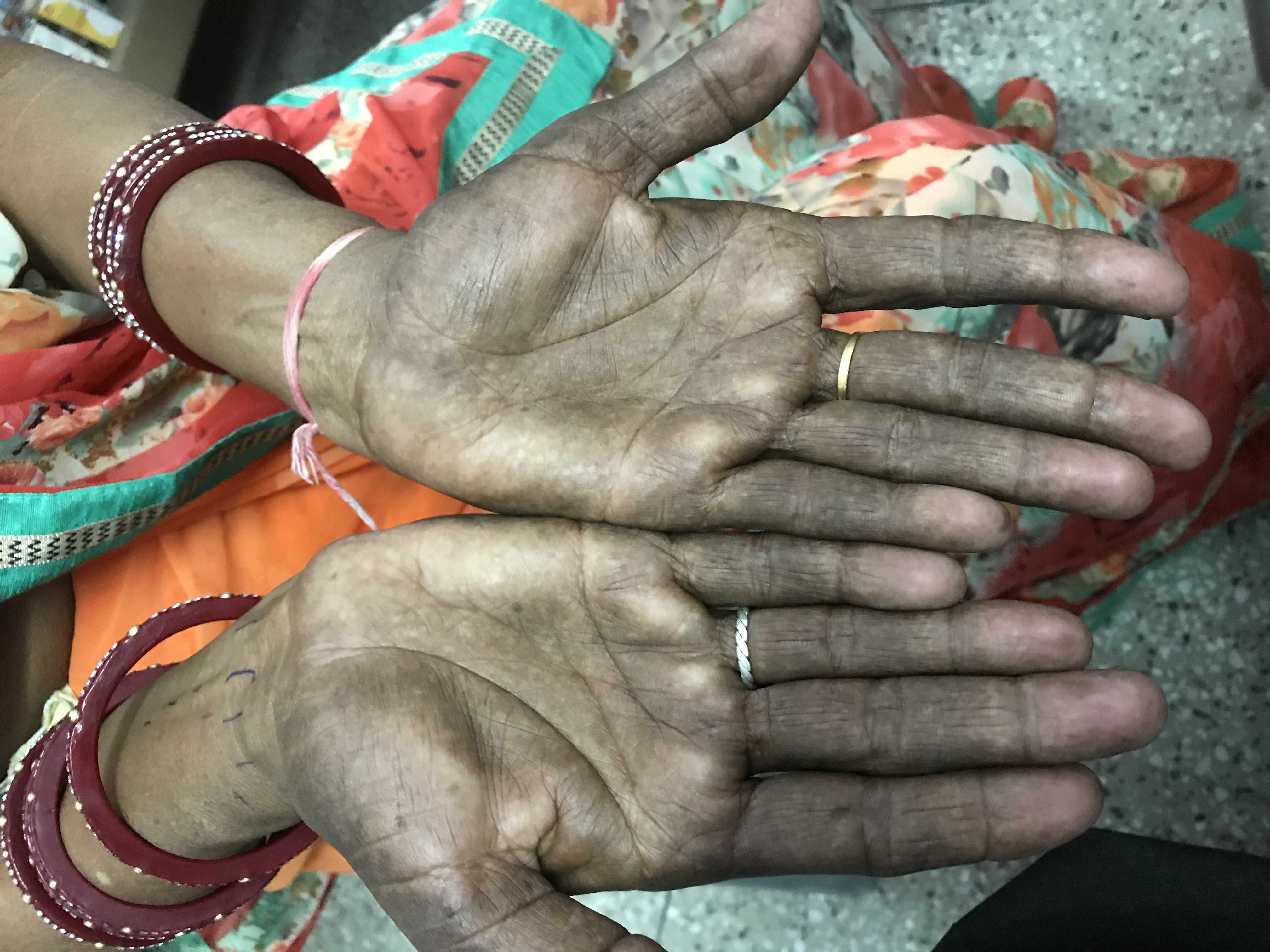 What Is The Cause Of Black Hands?